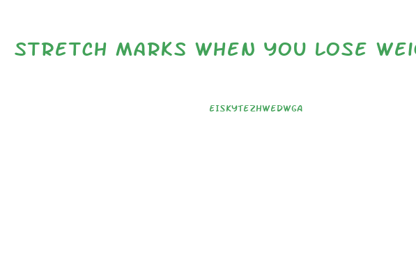 Stretch Marks When You Lose Weight