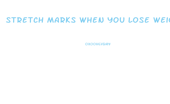 Stretch Marks When You Lose Weight