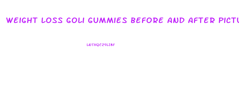 Weight Loss Goli Gummies Before And After Pictures