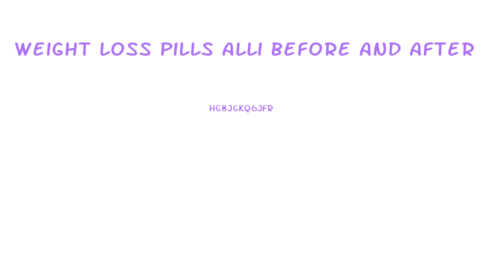 Weight Loss Pills Alli Before And After