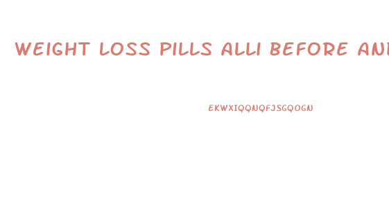 Weight Loss Pills Alli Before And After