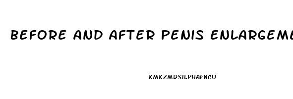 Before And After Penis Enlargement Surgery