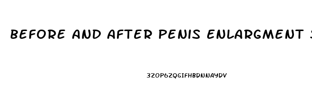 Before And After Penis Enlargment Surgery