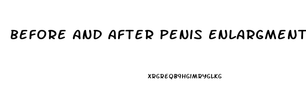 Before And After Penis Enlargment Surgery