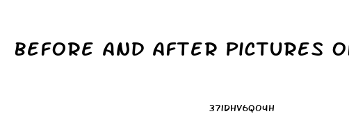 Before And After Pictures Of Penis Enlargement