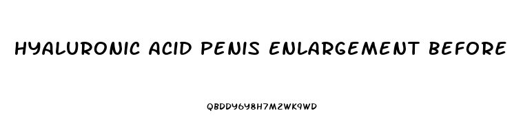 Hyaluronic Acid Penis Enlargement Before And After