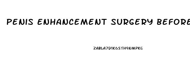 Penis Enhancement Surgery Before After