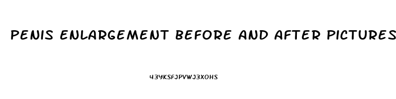 Penis Enlargement Before And After Pictures