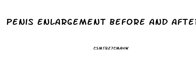 Penis Enlargement Before And After Surgery