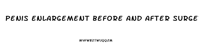 Penis Enlargement Before And After Surgery