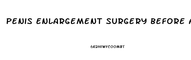 Penis Enlargement Surgery Before And After