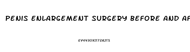 Penis Enlargement Surgery Before And After Erect