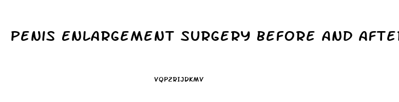 Penis Enlargement Surgery Before And After Photos