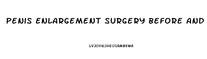 Penis Enlargement Surgery Before And After Pics