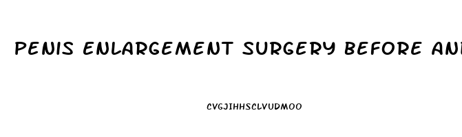 Penis Enlargement Surgery Before And After Pictures