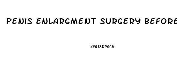 Penis Enlargment Surgery Before After