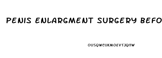 Penis Enlargment Surgery Before And After