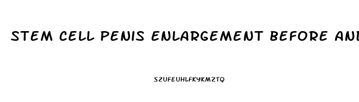 Stem Cell Penis Enlargement Before And After