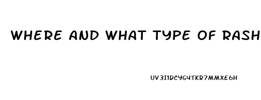 Where And What Type Of Rash Occurs With Sildenafil