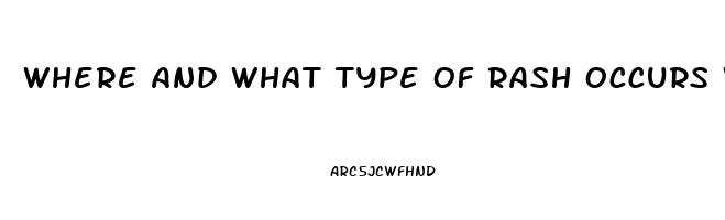 Where And What Type Of Rash Occurs With Sildenafil