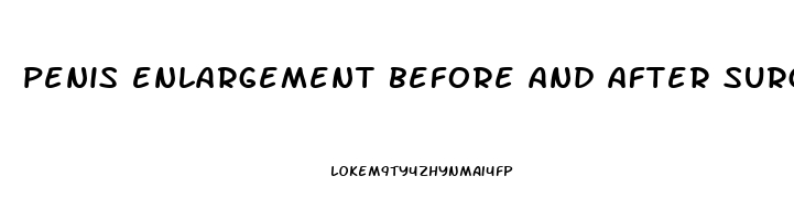 penis enlargement before and after surgery