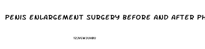 penis enlargement surgery before and after photos